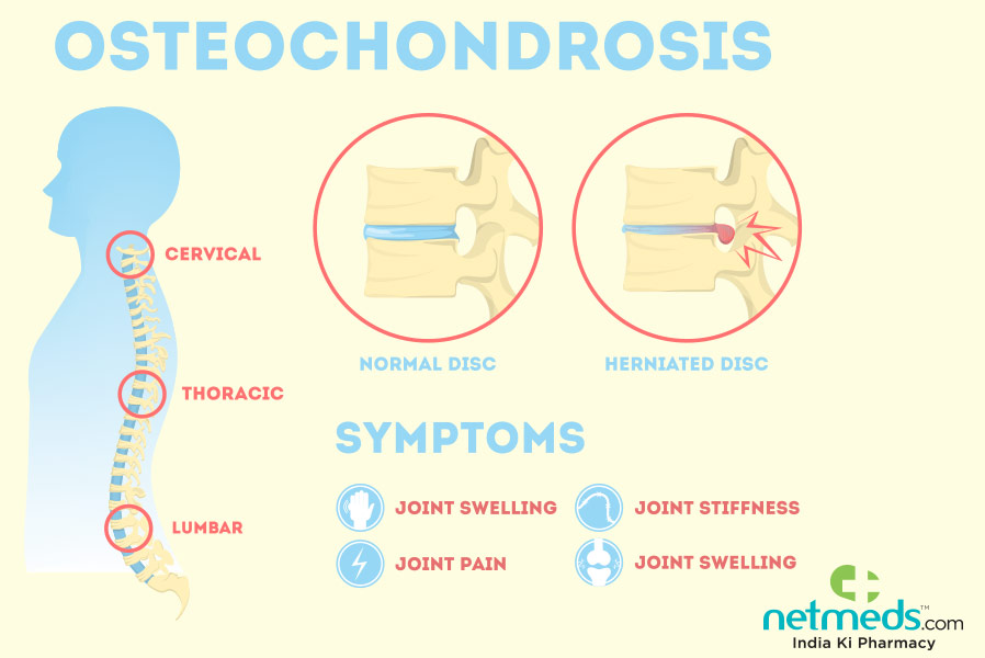 osteohondroza